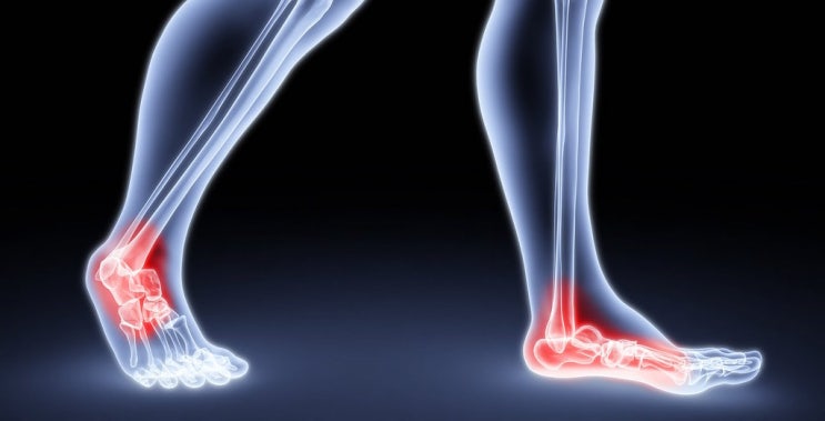 [질병 정보] 발목 염좌 (1) - 발목은 왜 삐는 걸까?