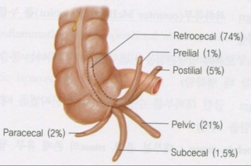 appendicitis (충수염) : 네이버 블로그