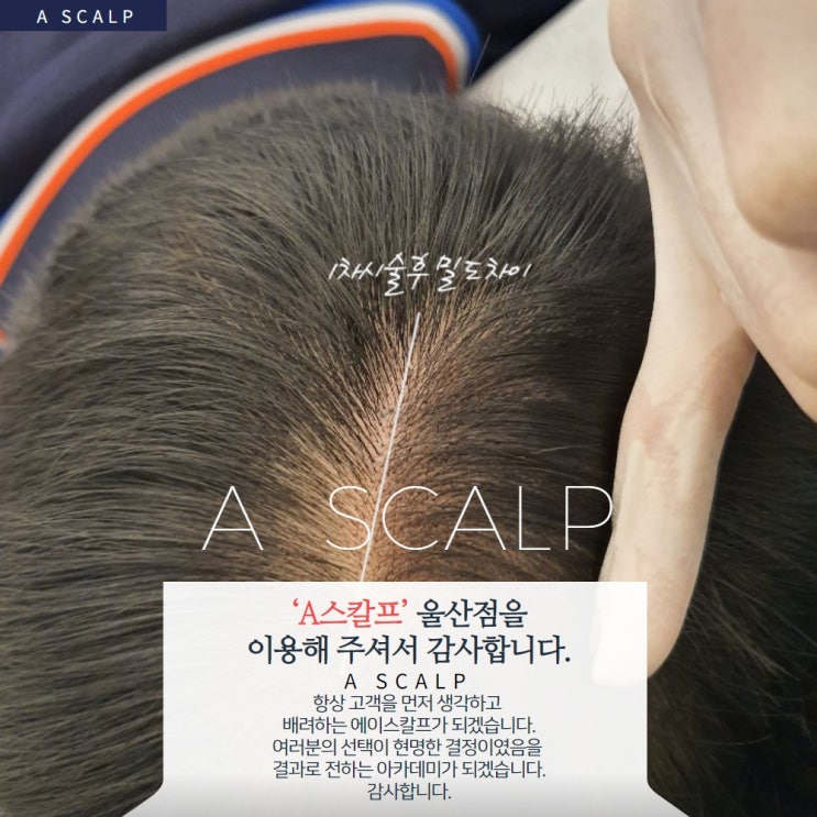  울산두피문신 에이스칼프 유명한 이유가 있습니다