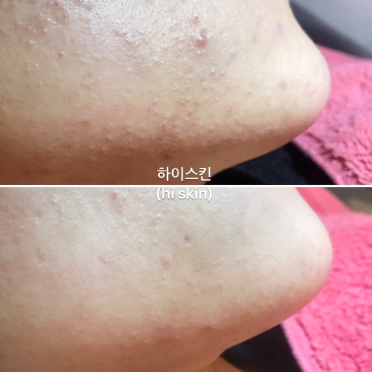  좁쌀여드름압출 화농성여드름압출 여드름압출잘하는곳 구로디지털단지피부관리실 하이스킨