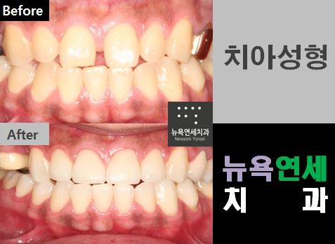  벌어진 앞니를 치아 교정하지 않고 라미네이트로 치과 치료를 받을 수 있습니다.