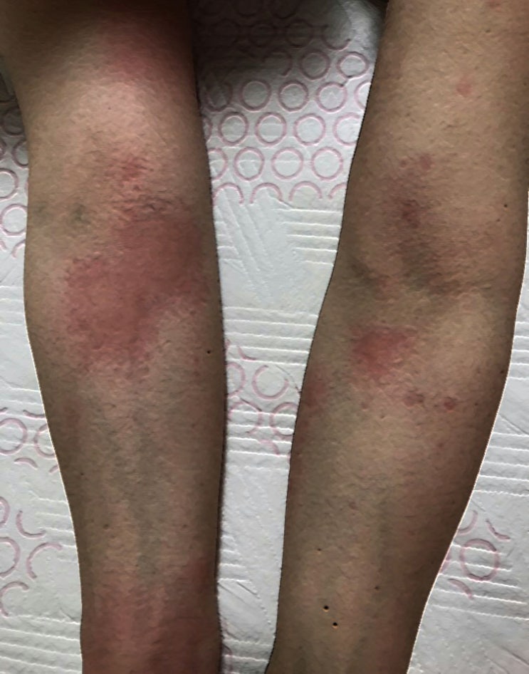 한랭 두드러기 : 가려움이 심해요