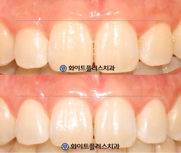  좌우 잇몸 높이가 다른 치아의 잇몸 성형 / 보라매치과