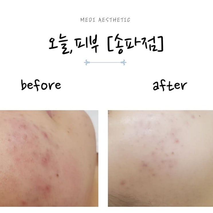  오늘피부 송파점 / 피부일기1