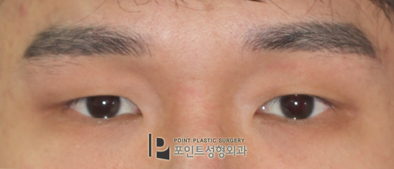 남성의 눈빛 교정 리뷰로 만들어내는 변화! 1