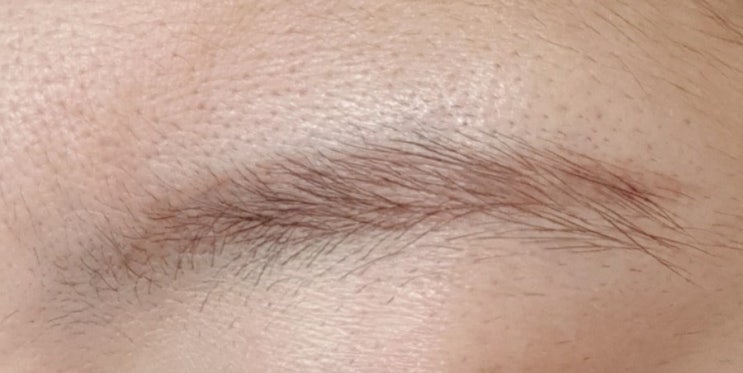 눈썹문신제거 2차 후기/ 눈썹반영구제거/ 붉은눈썹제거