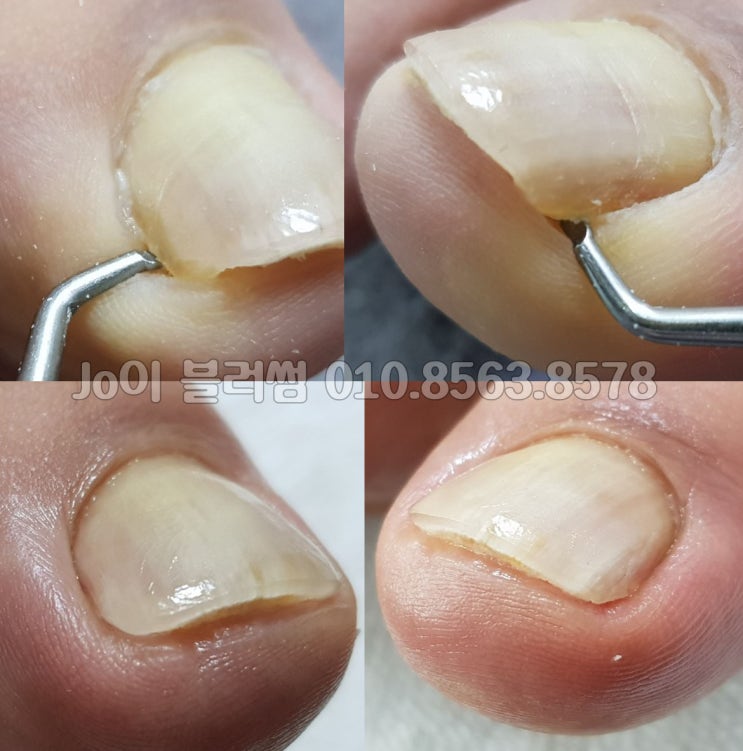  용인남자발톱무좀, 무좀발톱으로 고민하시는 분들을 위한 관리 네일샵 조이블러썸.
