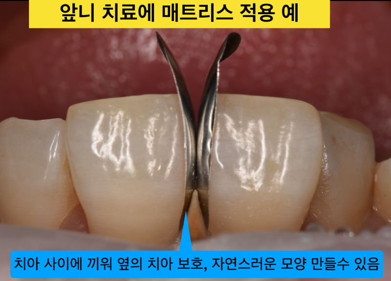 앞니 충치 치료 시 치아 손상을 최소화하는 방법