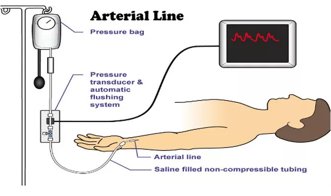 Arterial catheter A-lin 동맥내혈압 : 네이버 블로그