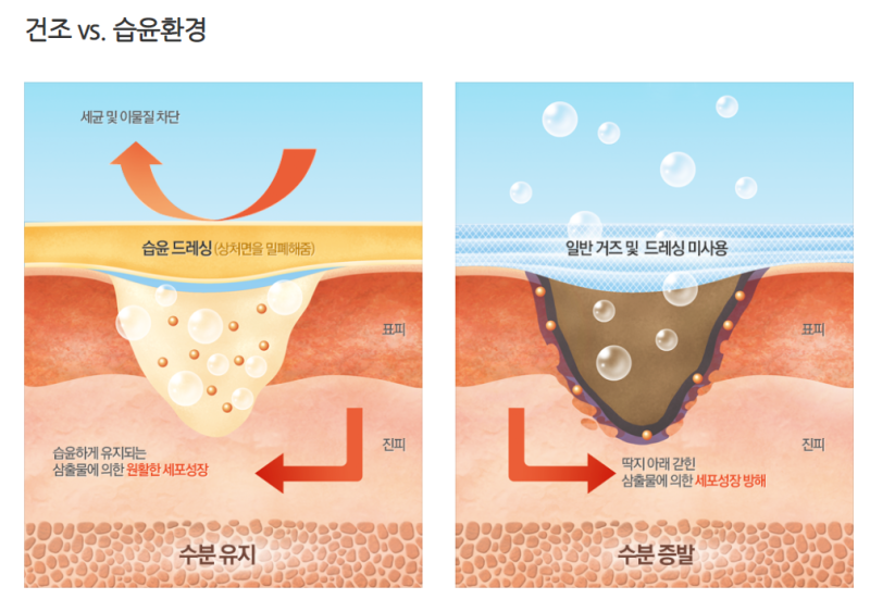 내 상처에 따른 올바른 상처 처치 방법은?! : 네이버 블로그