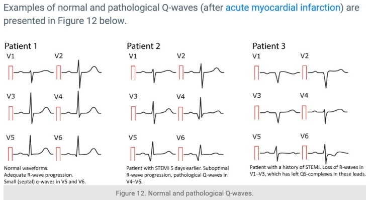 [ECG 기초] QRS complex : 네이버 블로그
