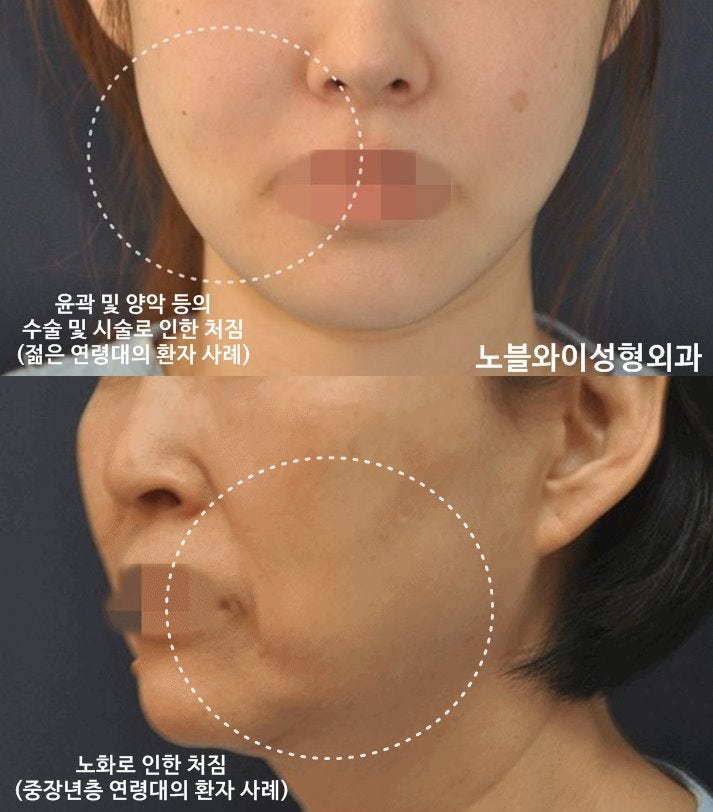 구로성형외과 빠른 이중턱, 처진 볼 PICK 얼굴살빼기