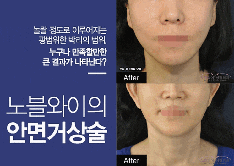 볼살리프팅 하기 전 이것만은 알아두자! 볼살리프팅 하기 전 이것만은 알아두자!