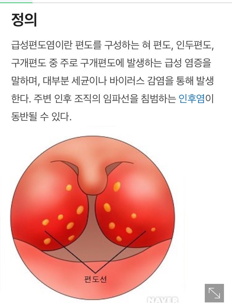 편도선염이 자주 발생하면 만성화될 수 있음