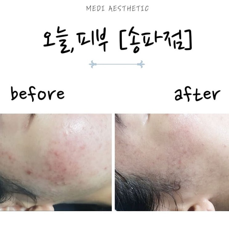  송파여드름관리 오늘피부 송파점 피부일기3