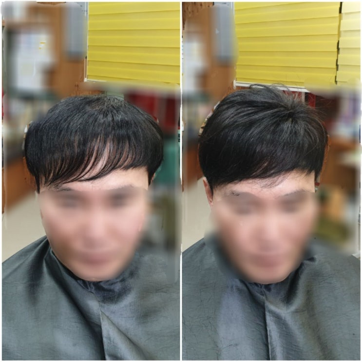  40대 남성탈모 보톡스증모술로 해결