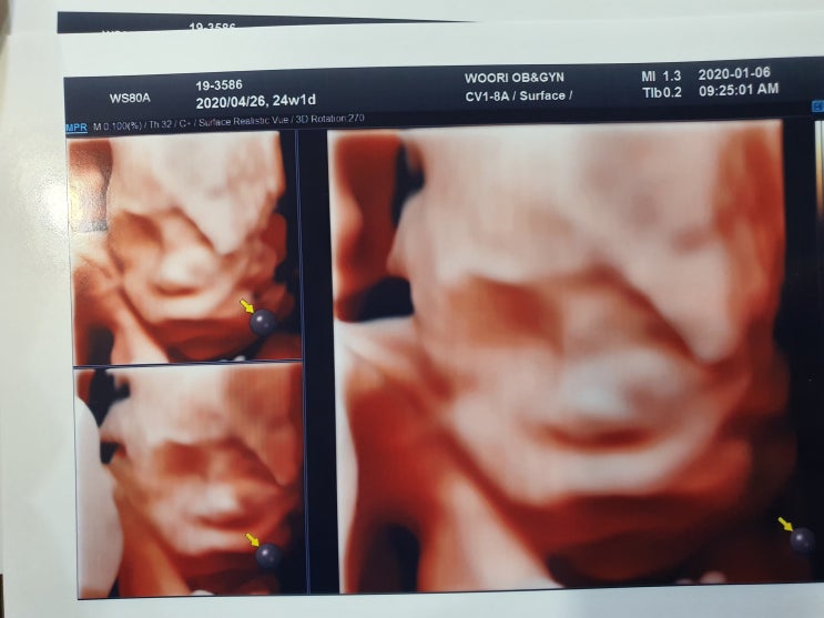 [임신일기]임신 24주 임당검사