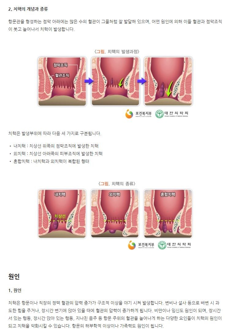 치질수술 후기- 치핵근본절제술, 한국 건강보험의 위대함 : 네이버 블로그