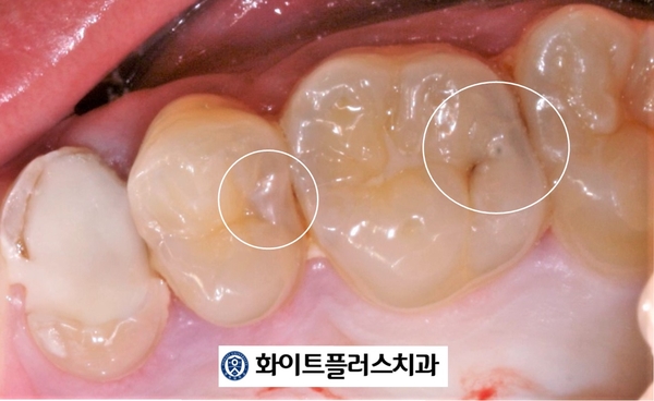  치아 사이가 썩었어요 -  보라매치과 인접면 충치의 치료