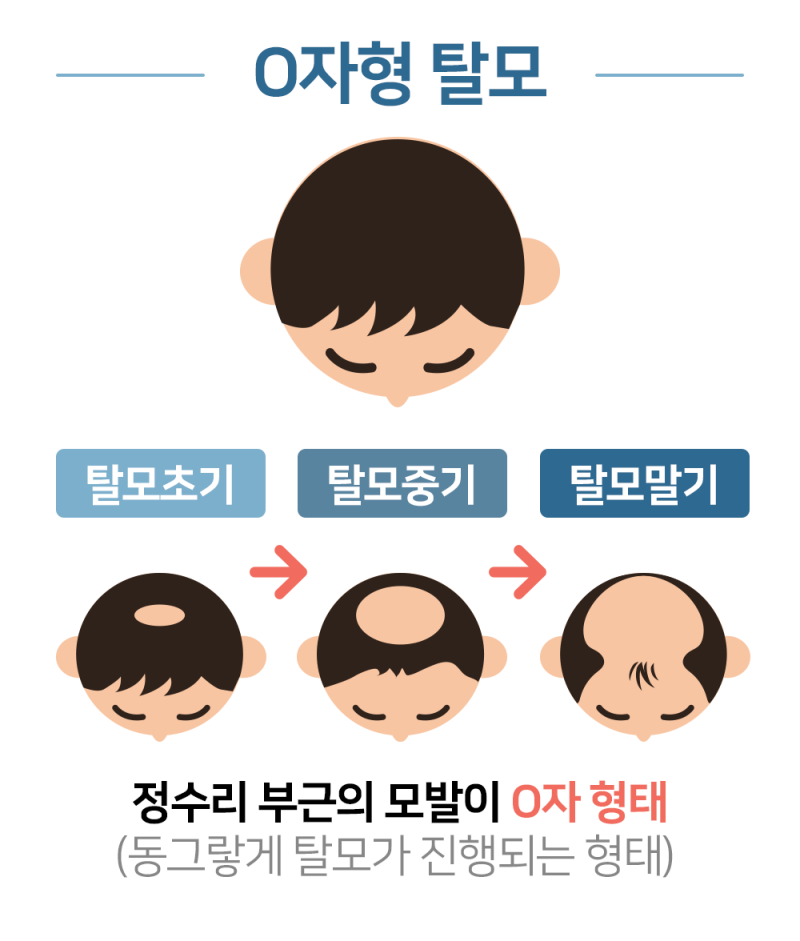 탈모원인/증상/탈모예방법까지 한번에 알아본다 4