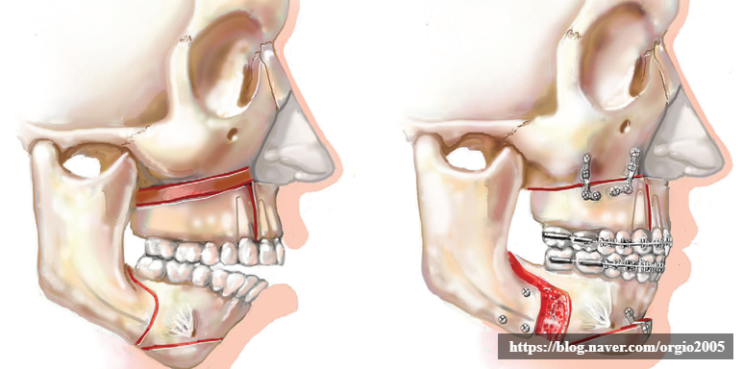 양악수술&gt; 양악수술은 오래 걸리는 수술인가?