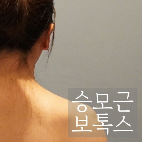 강남역 피부과에서 승모근 보톡스 맞고 온 리뷰!
