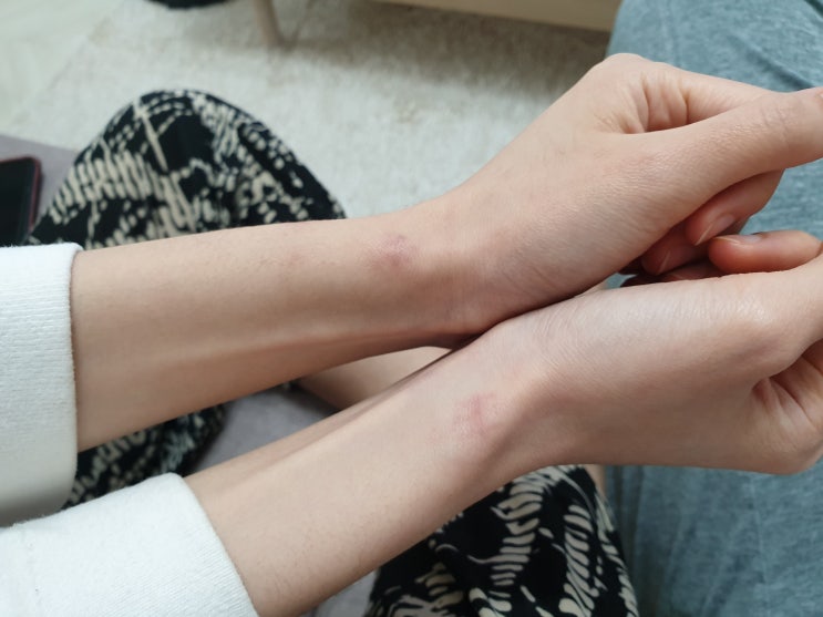 손목 건초염 드퀘르벵 수술 3개월 경과 후기(엄지손가락 통증)