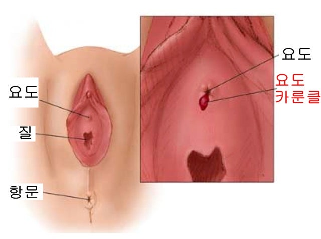 여성 요도염증 골반염의 차이를 알고 싶습니다.
