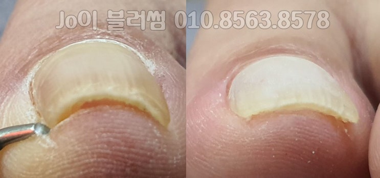  파고드는발톱 관리를 너무 잘해서 서울까지 소문난 네일샵 조이블러썸
