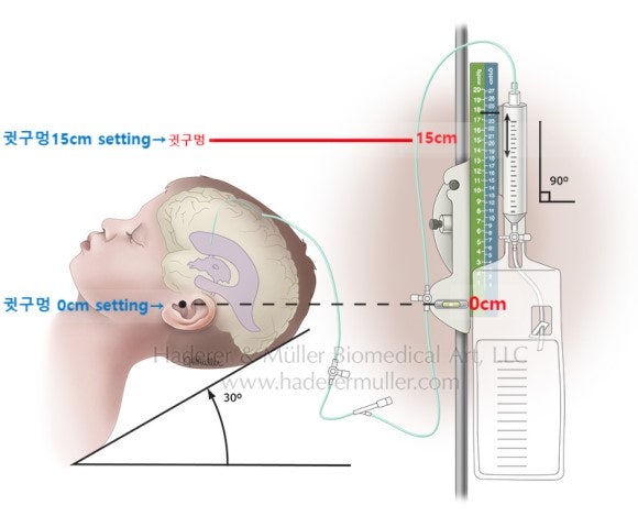 EVD(External ventricular drainage, 뇌실외배액) : 네이버 블로그