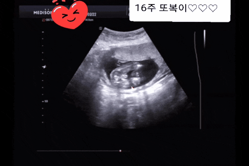 2차기형아 검사 16주 5일 또복이의 성별은 과연? 2차기형아 검사 16주 5일 또복이의 성별은 과연?