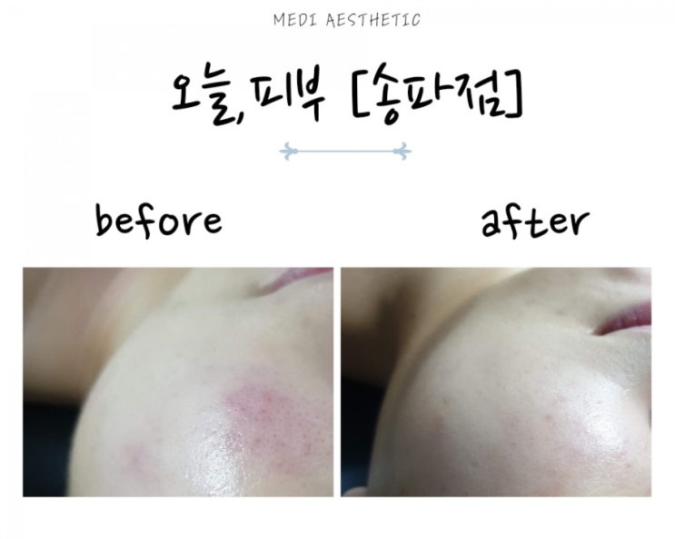  방이동 여드름관리 오늘피부 일기4