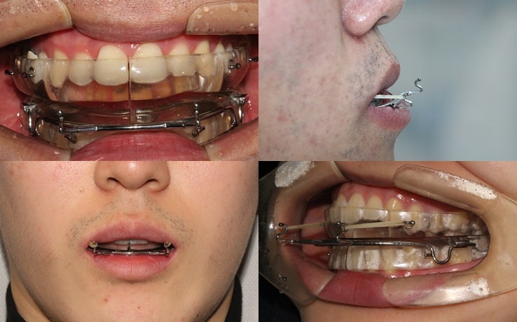 주걱턱교정기 종류 및 치열교정 후기사례 공유
