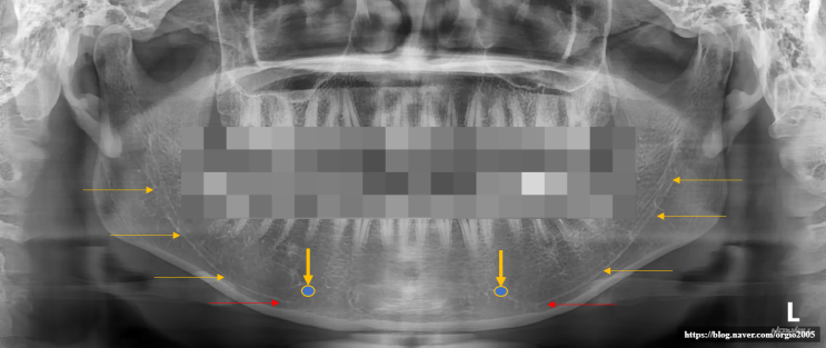 윤곽수술&gt; 턱끝 수술 후 신경 부작용은 왜 생기는 것일까?