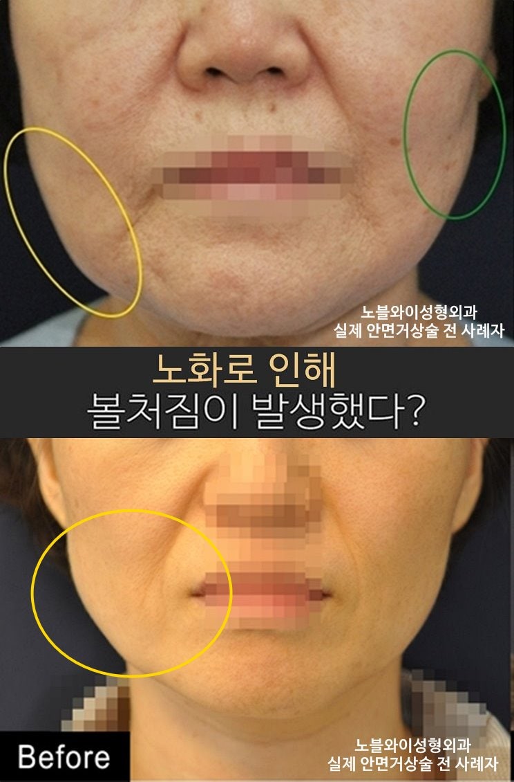 늘어진 얼굴 리프팅 커스텀 울셀라 B급품 성공률!