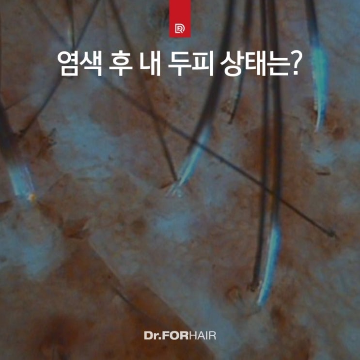 신방화역 탈모두피관리 염색과 탈색 후의 모발과 두피, 머릿결 상태! 신방화역 탈모두피관리 염색과 탈색 후의 모발과 두피, 머릿결 상태!
