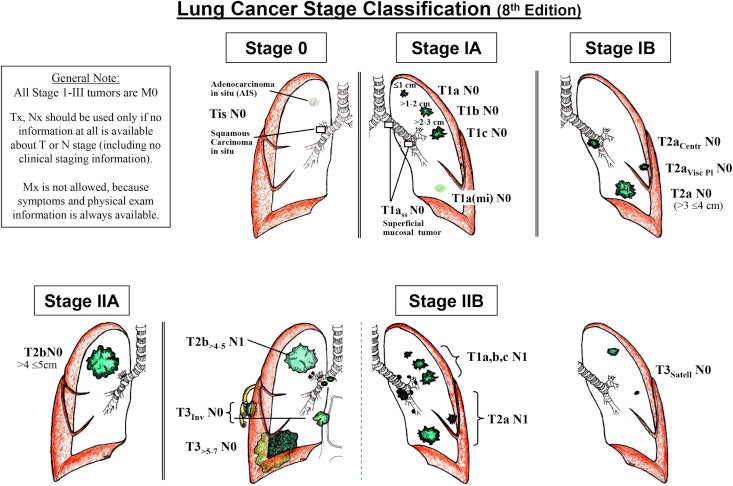 Radiation Therapy For Lung Cancer radiation-therapy-for-lung-cancer