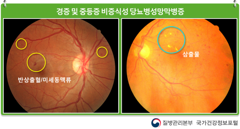 당뇨병성망막병증 증상 : 네이버 블로그