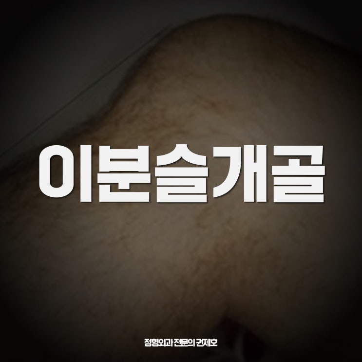  이분 슬개골 bipartite patella 붙지 않은 뼈제거
