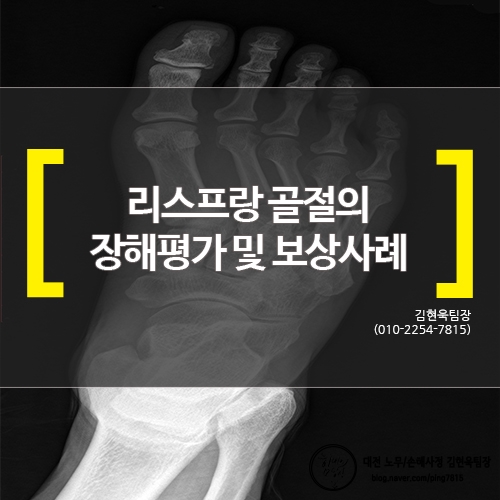  [대전손해사정] 리스프랑 골절의 장해평가 및 보상사례