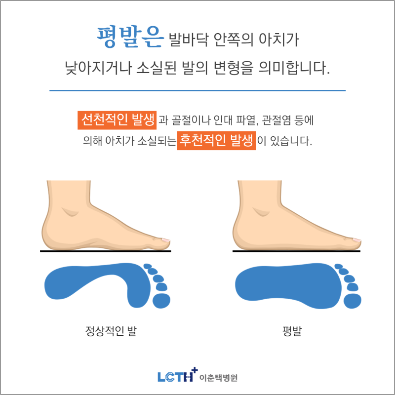 평발 관절에 악영향을 미칠 수 있음