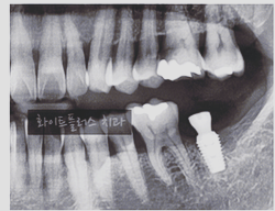 보라매 치과 발치후 임플란트까지 기다리는 시간