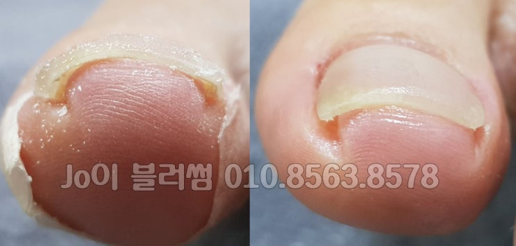  내향성발톱, 파고드는발톱을 제대로 펴주고 만들어가면서 관리해주는 용인 광교 수지 네일샵 조이블러썸