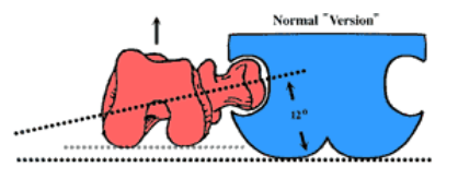 ‘전경(anteversion)/후경(retroversion)’, ‘전념(antetorsion)/후념(retrotorsion ...