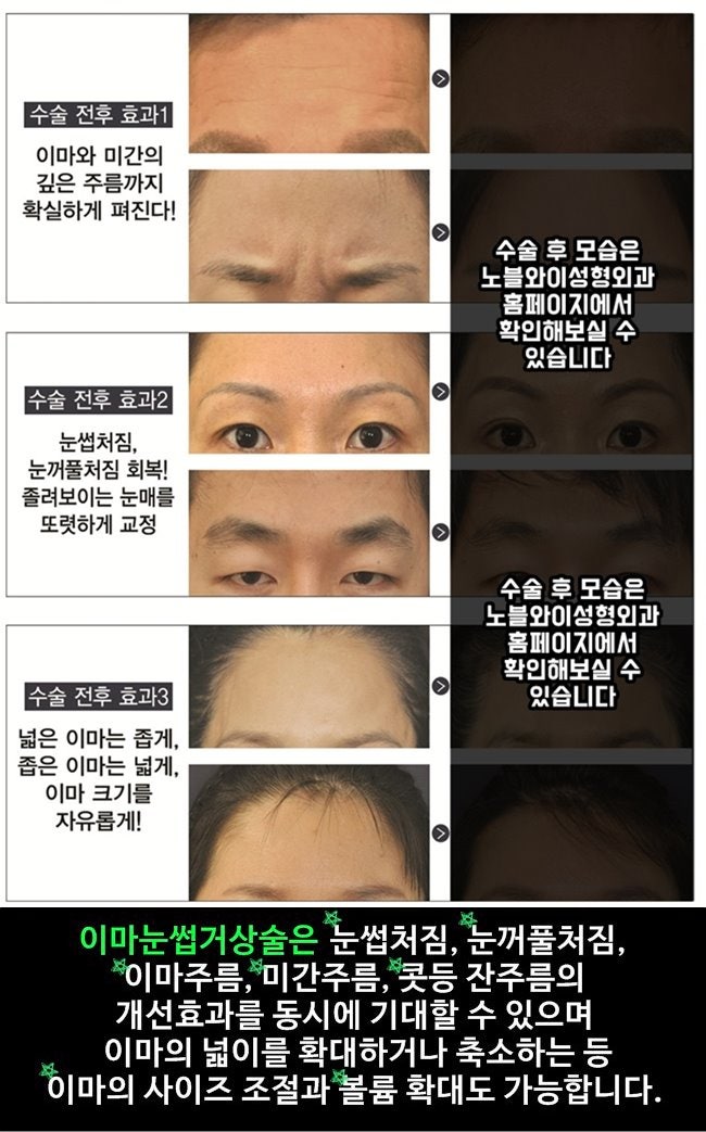 이마사 리프팅 자연스러운 이미지 변화로