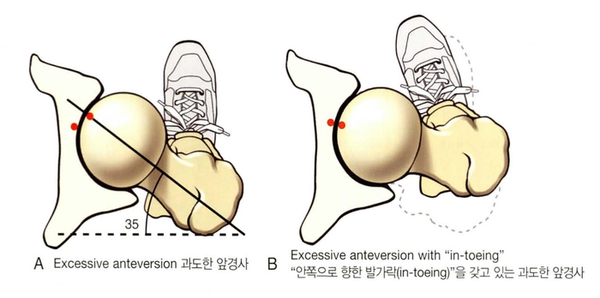 ‘전경(anteversion)/후경(retroversion)’, ‘전념(antetorsion)/후념(retrotorsion ...