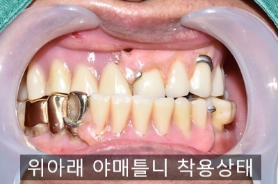  [종로/시청역]실제 환자의 보험 임플란트, 보험 틀니 사례 소개합니다. 젊어지는틀니,임플란트 치료