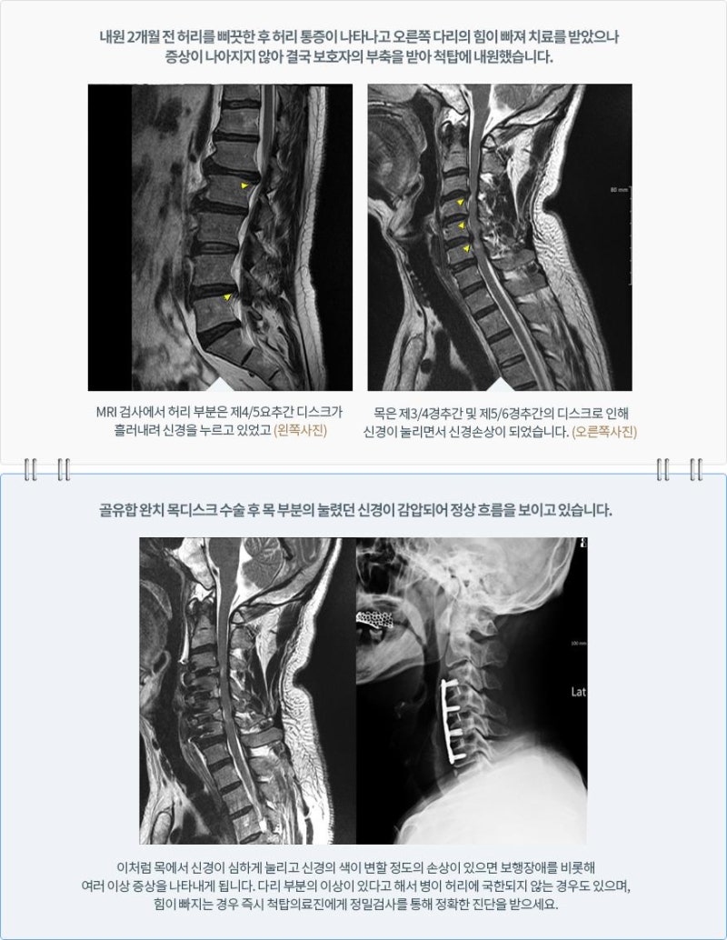 고도 비만 다이어트 발목 골절 수술.척추협착증. 퇴행성 디스크 파열, 원인, 증상, 치료.자가진단법, 디스크 검사(MRI·MRI). CT. X-ray. 엑스레이) 비용예방·완치·후기