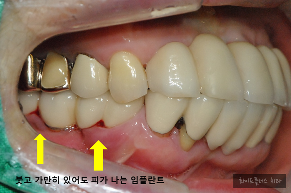 신대방 치과 임플란트 염증의 치료 사례
