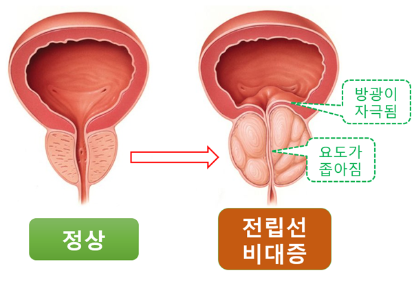  국소마취  전립선 결찰술, 유로리프트 시술의 특징